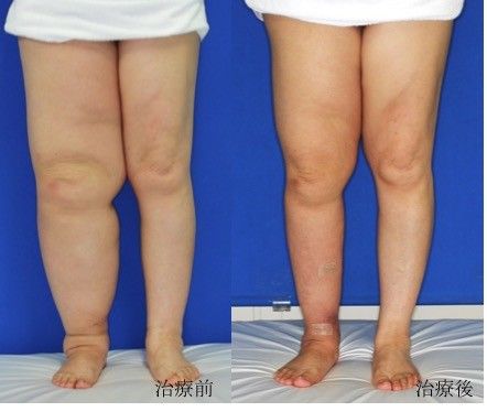 リンパ浮腫 早期治療を 腕や脚のみくみ 重だるい がん手術後の変化に注意 社会 下野新聞 Soon ニュース 下野新聞 Soon スーン